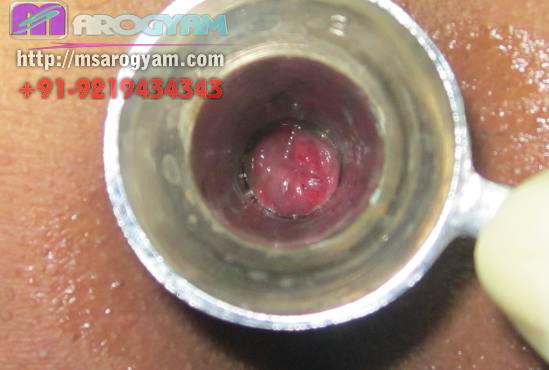 c hegres nude erotic ball hard and protruding hemorrhoid